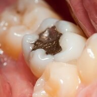 Chinese dental Crowns